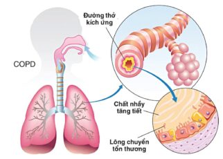 Biện pháp khắc phục bệnh COPD
