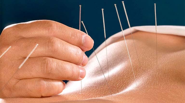 Châm cứu là phương pháp trị liệu