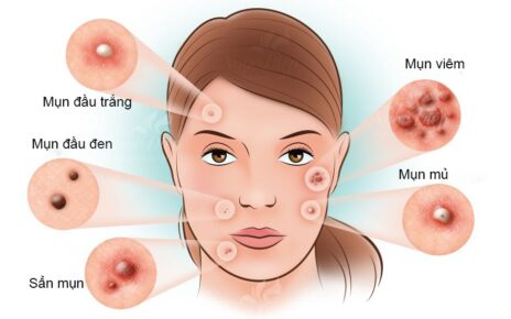 Lưu ý cách điều trị mụn trứng cá