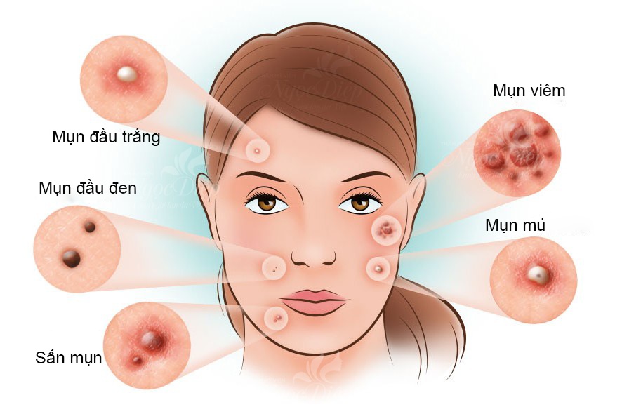 Lưu ý cách điều trị mụn trứng cá