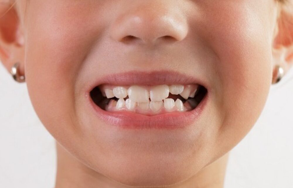 Bệnh nghiến răng và kinh nghiệm chữa trị