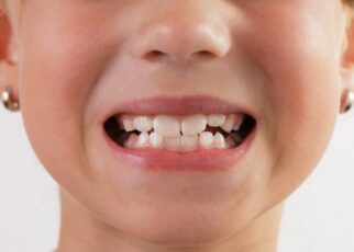 Bệnh nghiến răng và kinh nghiệm chữa trị